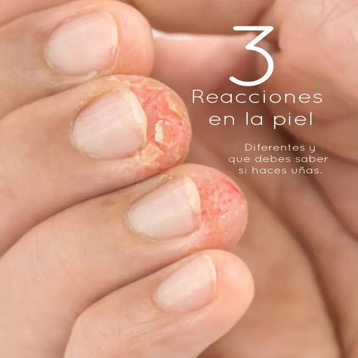 Reacciones de la Piel por Productos de Uñas: Tres Diferencias que Debes Conocer